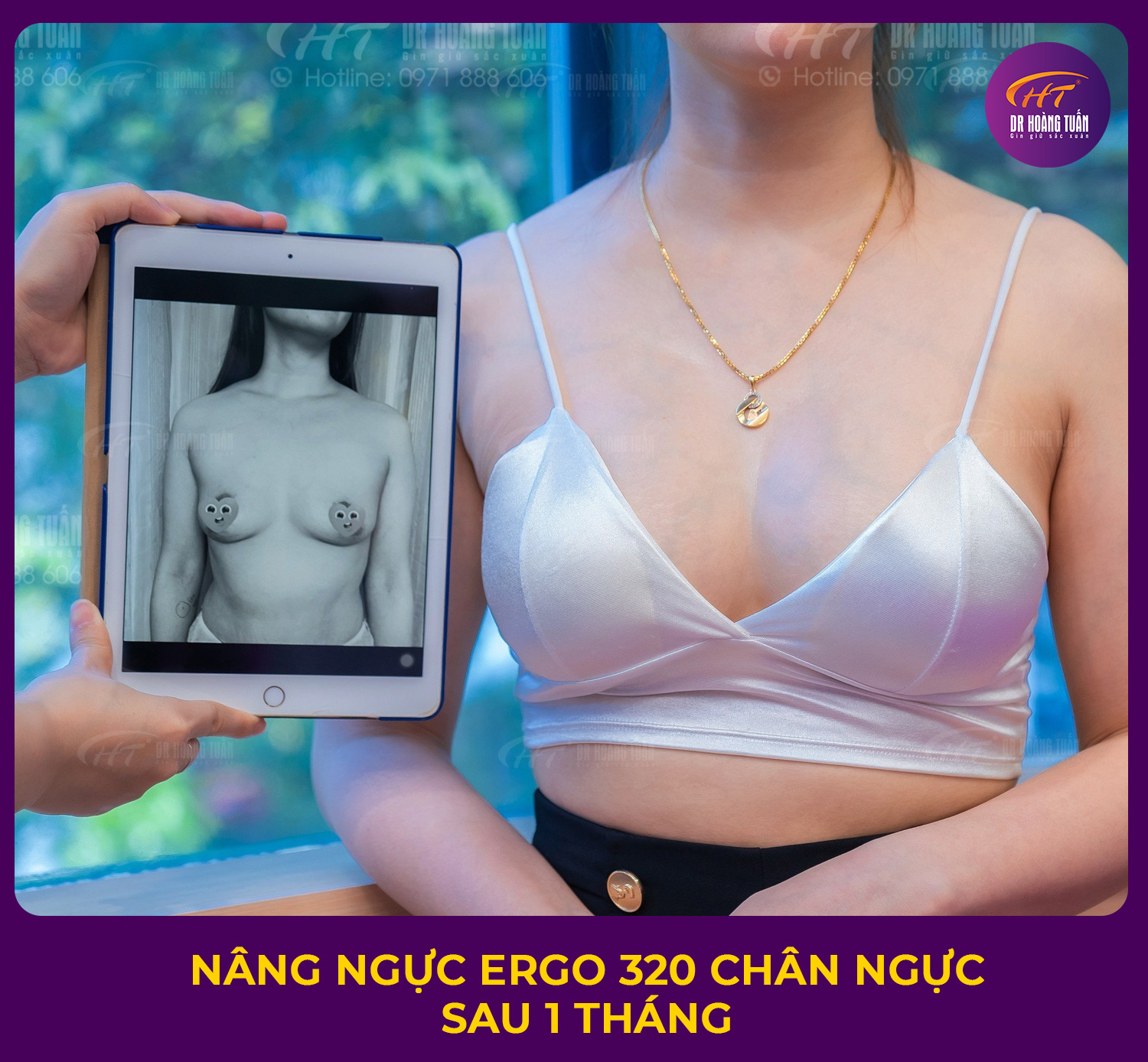 Kết quả nâng ngực đường chân ngực - Dr Hoàng Tuấn